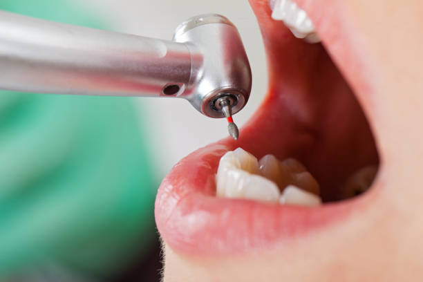 Best Emergency Root Canal Treatment in South San Gabriel, CA